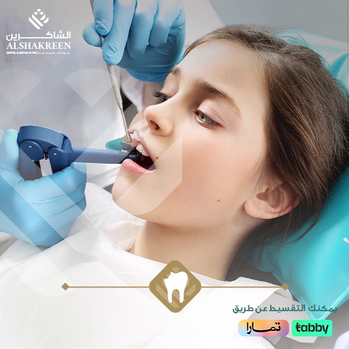 علاج تسوس الاسنان | عيادات الشاكرين 
