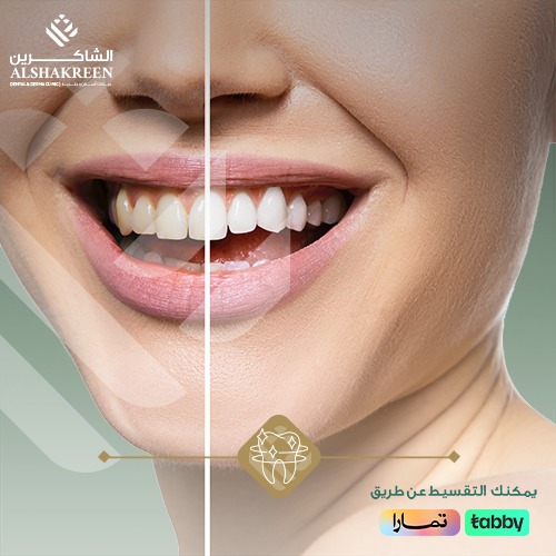 تبييض الاسنان | عيادات الشاكرين