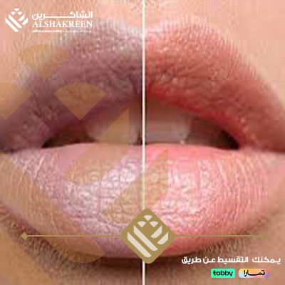 توريد شفايف | عيادات الشاكرين 