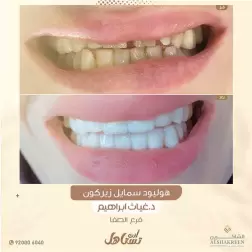 <p>إبتسامة هوليوود</p>

<p>اهم عروض الاسنان&nbsp;</p>

<p><a href="https://alshakreen.net/public/ar/offers/Dental-offers">تنظيف الاسنان&nbsp;</a></p>

<p><a href="https://alshakreen.net/public/ar/offers/Dental-offers?page=2">تقويم الاسنان&nbsp;</a></p>

<p>&nbsp;</p>